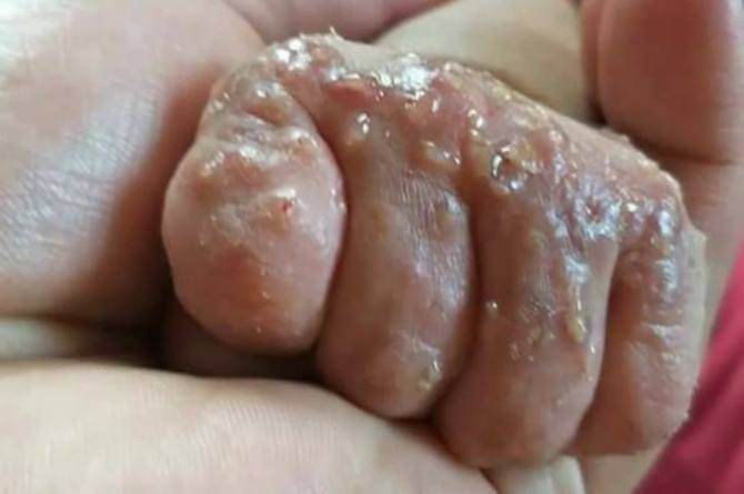 Scabies In Infants Symptoms How It Spreads And Its Treatment
